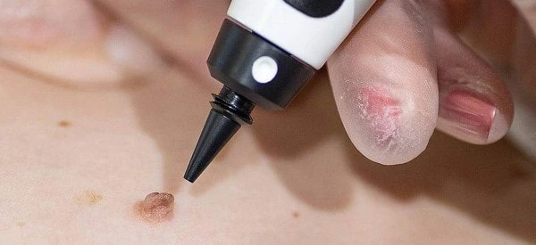 skin tag removal using cryopen Hassocks