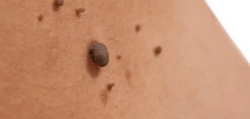 image of a skin tag Hassocks