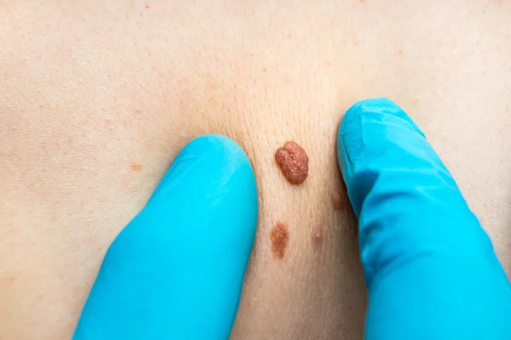 Consultant examining a skin tag Hassocks