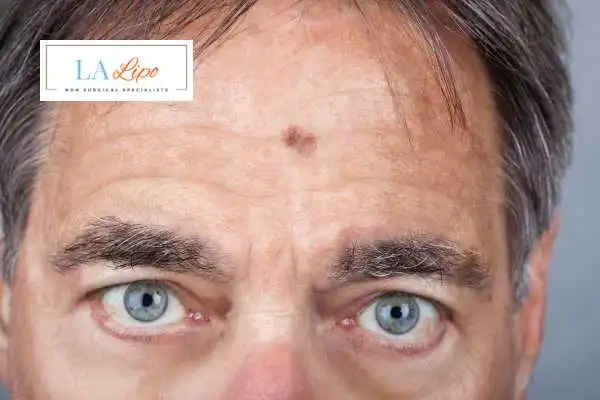 Solar Lentigo Removal Hassocks image of man with mark on his forehead