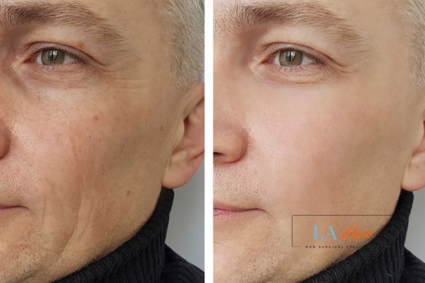 See the amazing results of Morpheus8 Treatment Hassocks!